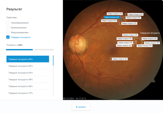 Система скрининга диабетической ретинопатии